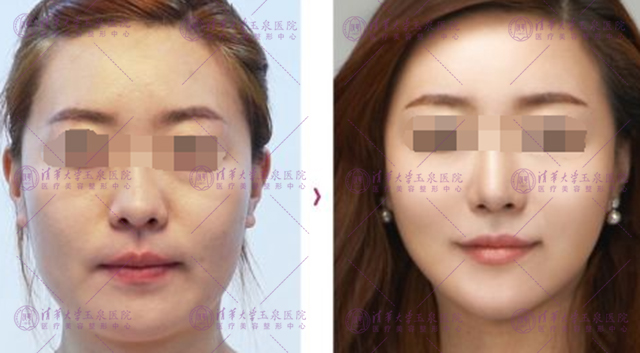 超声刀和热玛吉区别适合人群,热玛吉和超声刀该怎么选