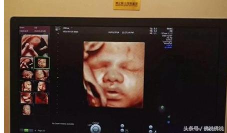 做四维彩超有什么关注事项,做四维彩超的关注事项是什么