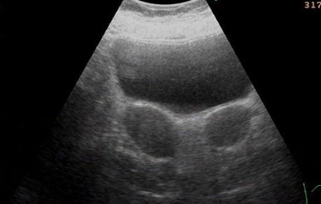 双子宫畸形是什么原因,双子宫畸形发病率