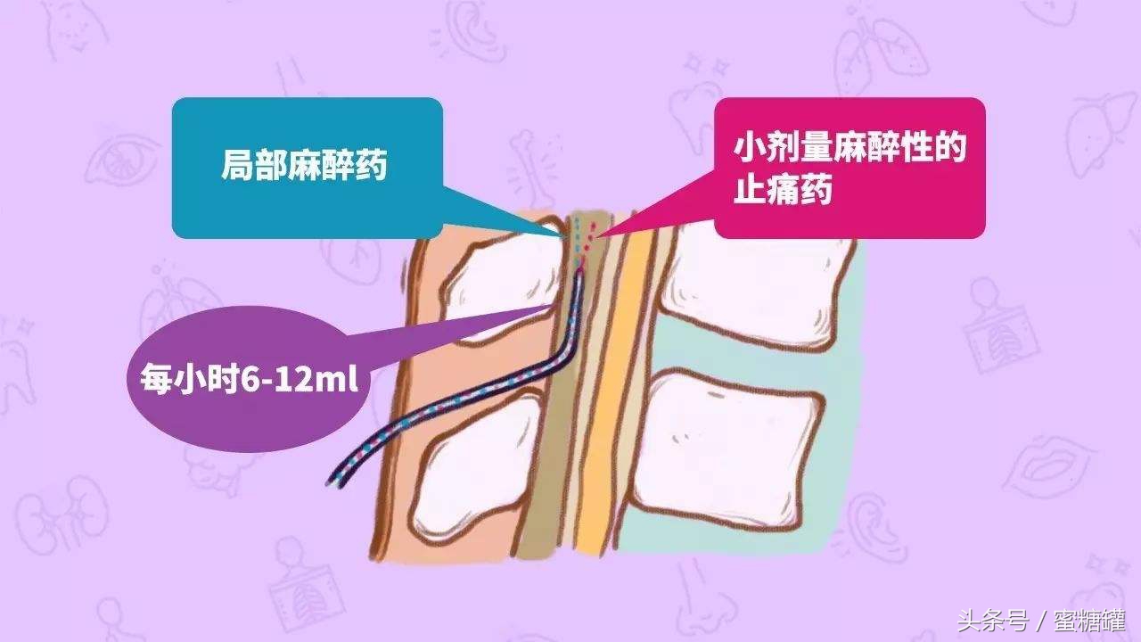 无痛分娩针安全吗对胎儿有影响吗,无痛分娩会导致胎儿缺氧吗