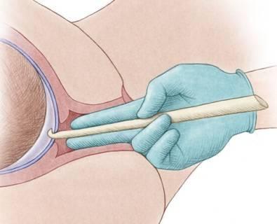 孕妇超过预产期不生怎么办,超过41周没生属于过期妊娠吗