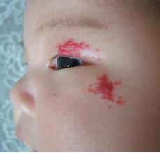 血管瘤好可怕，孕妈妈该怎么预防？