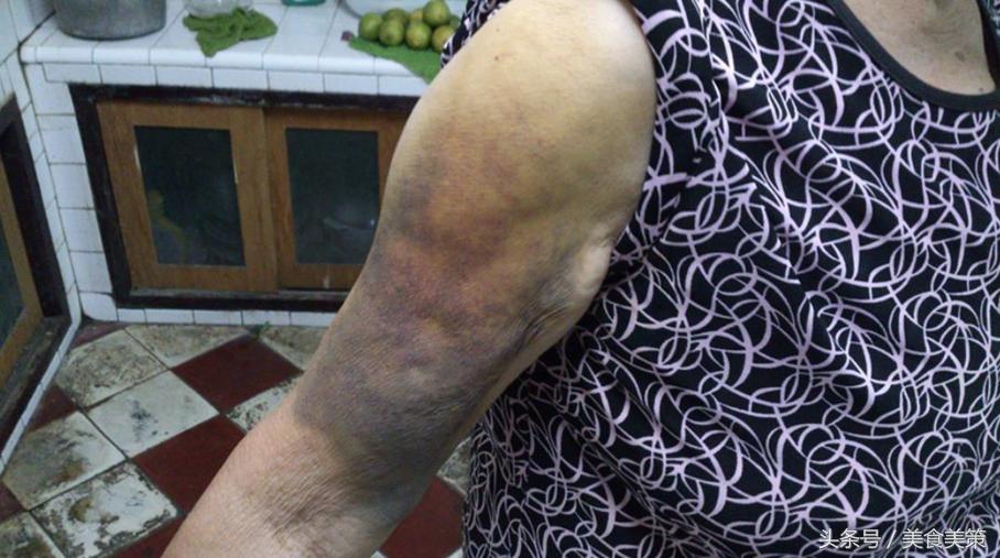 老婆婆胳膊受伤,身上一碰就容易淤青吃什么水果