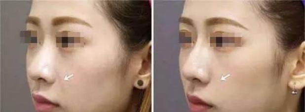 超声刀多久做一次？超声刀做完会反弹吗？