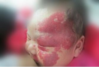 血管瘤好可怕，孕妈妈该怎么预防？