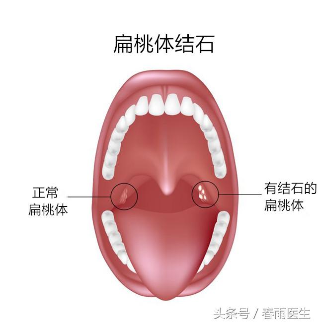 嘴里的白色发臭的颗粒是什么,嘴里吐出白色恶臭的颗粒怎么治疗
