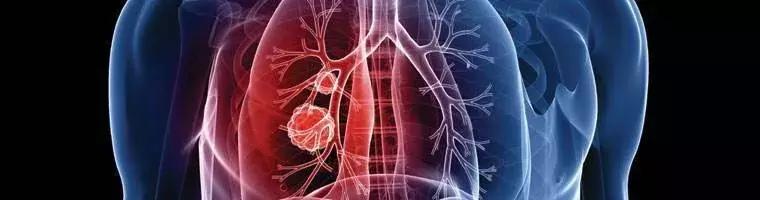 柳叶刀治胃癌效果,劳拉替尼肺癌第三代靶向药