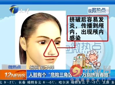 郑州13岁女孩挤痘痘诱发败血症,小伙挤痘痘肾衰竭