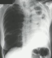 《慢性肺曲霉病：诊断和治疗的理论基础及临床指南》解读