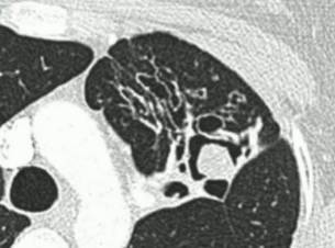 《慢性肺曲霉病：诊断和治疗的理论基础及临床指南》解读