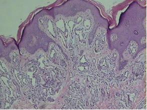 血管瘤好可怕，孕妈妈该怎么预防？
