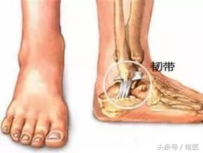 骨科脚崴了怎么处理,骨科脚踝扭伤