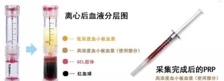 prp自体血清修复疗法,prp自体血清注射面部恢复期