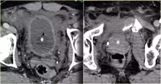 腹腔脏器炎症ct可以查出来吗,腹腔脏器ct表现图像