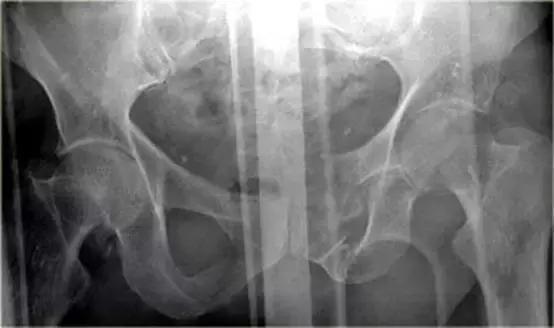 腹腔脏器炎症ct可以查出来吗,腹腔脏器ct表现图像