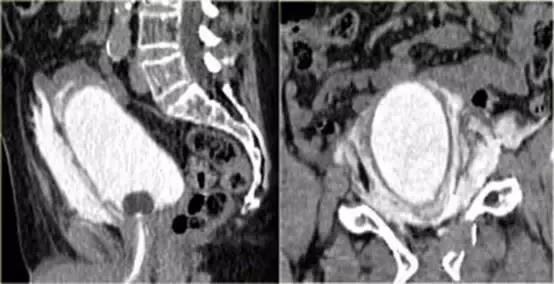 腹腔脏器炎症ct可以查出来吗,腹腔脏器ct表现图像