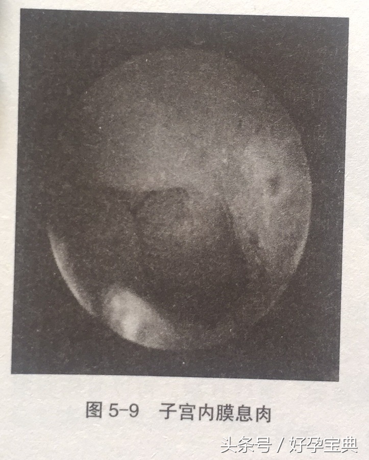 为什么宫腔会发生改变？宫腔改变为什么会导致不孕不育？