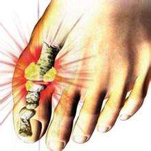 尿酸高痛风危险吗,尿酸高喝酒不痛风但是运动痛风