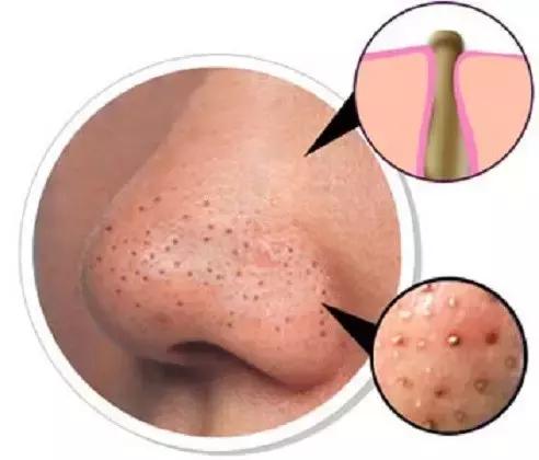 鼻子出油毛孔大黑头多怎么办,鼻子有粉刺黑头爱出油怎么办