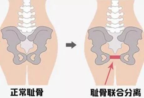 耻骨联合分离会影响入盆么,孕晚期耻骨联合分离不能顺产了么