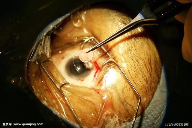 近视如何治疗比较好,近视的其他治疗