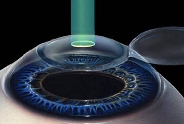 近视如何治疗比较好,近视的其他治疗