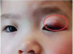 小孩眼皮起了个小红包,小孩眼皮长了个鼓包一摸就疼