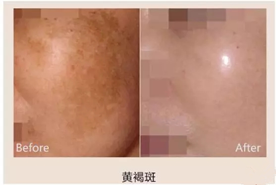 从出生就有的黄褐色斑,怎么区分黄褐斑和孕斑