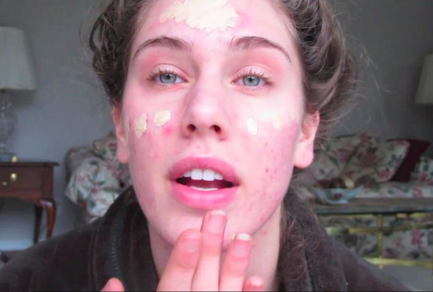 额头长痘是什么原因以及解决办法,额头长痘忌讳什么