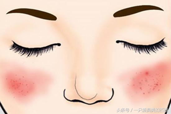 激光祛痘坑和光子嫩肤,打光子嫩肤会爆痘吗