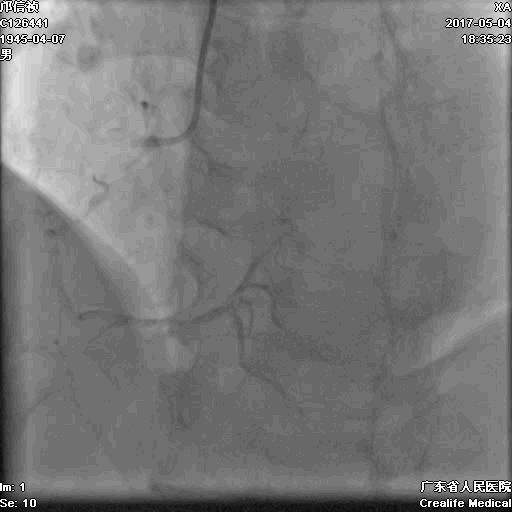 冠脉介入术的介绍,复杂冠脉介入病例
