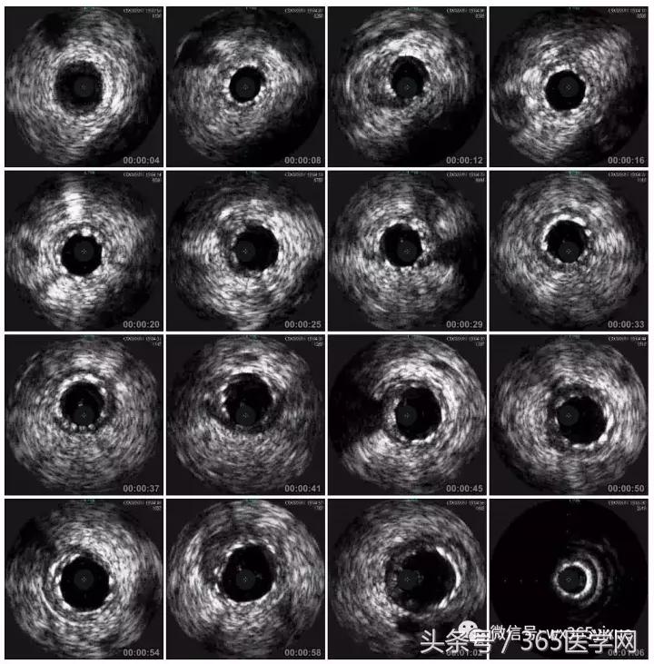 冠脉介入术的介绍,复杂冠脉介入病例