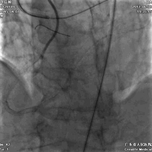 冠脉介入术的介绍,复杂冠脉介入病例