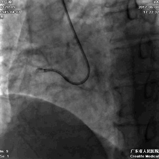 冠脉介入术的介绍,复杂冠脉介入病例