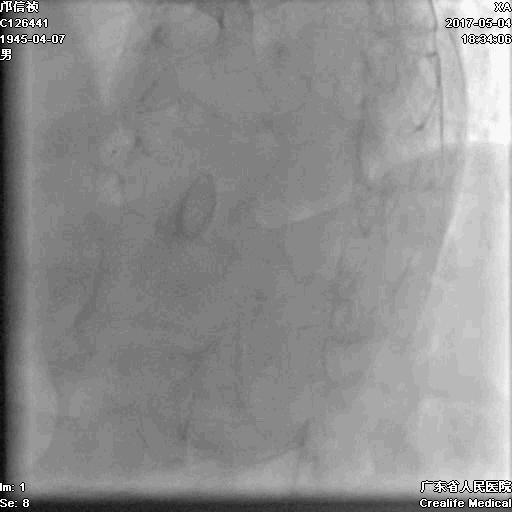 冠脉介入术的介绍,复杂冠脉介入病例