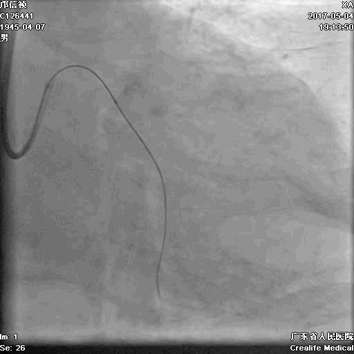 冠脉介入术的介绍,复杂冠脉介入病例