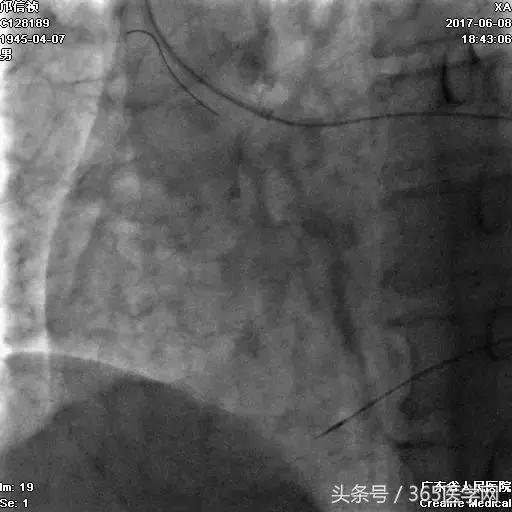冠脉介入术的介绍,复杂冠脉介入病例