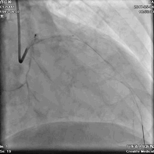 冠脉介入术的介绍,复杂冠脉介入病例