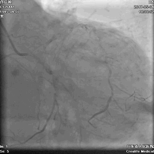 冠脉介入术的介绍,复杂冠脉介入病例