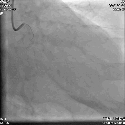 冠脉介入术的介绍,复杂冠脉介入病例