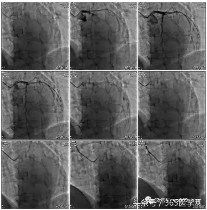 冠脉介入术的介绍,复杂冠脉介入病例