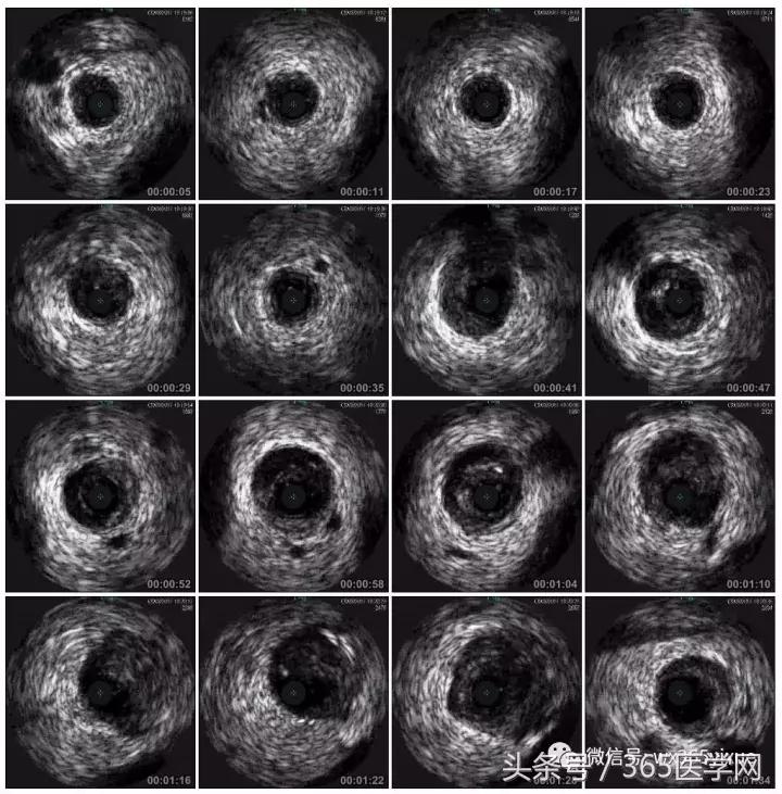 冠脉介入术的介绍,复杂冠脉介入病例