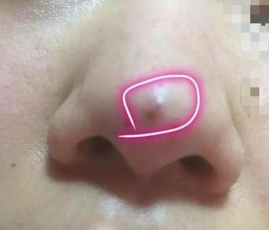 线雕的十大骗局,揭秘线雕埋线你不知道的内幕