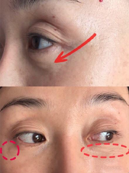 线雕的十大骗局,揭秘线雕埋线你不知道的内幕