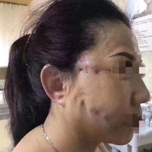 线雕的十大骗局,揭秘线雕埋线你不知道的内幕