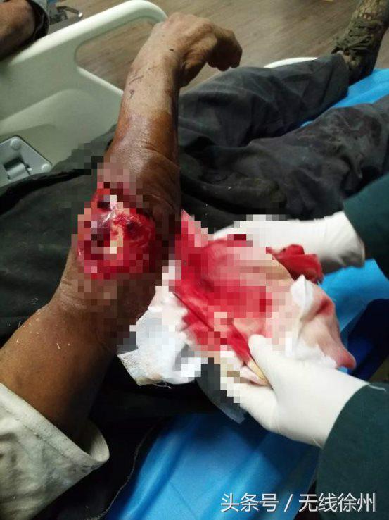 深秋警惕萌宠变“猛”宠，徐州仁慈昨夜连续收治2位被狗咬伤患者