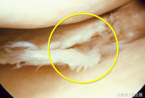 高中生膝盖疼痛的原因和解决方法,爬楼梯膝盖疼痛的原因和解决方法