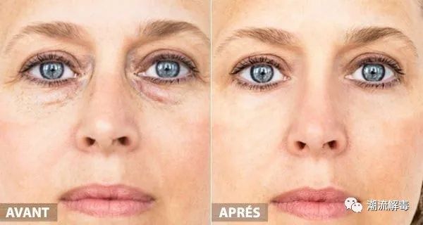 怎样让已经变老的眼睛恢复年轻,眼睛衰老什么方法可以消除皱纹