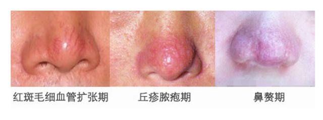 为啥你是西方的玫瑰却是东方的*疮痤**