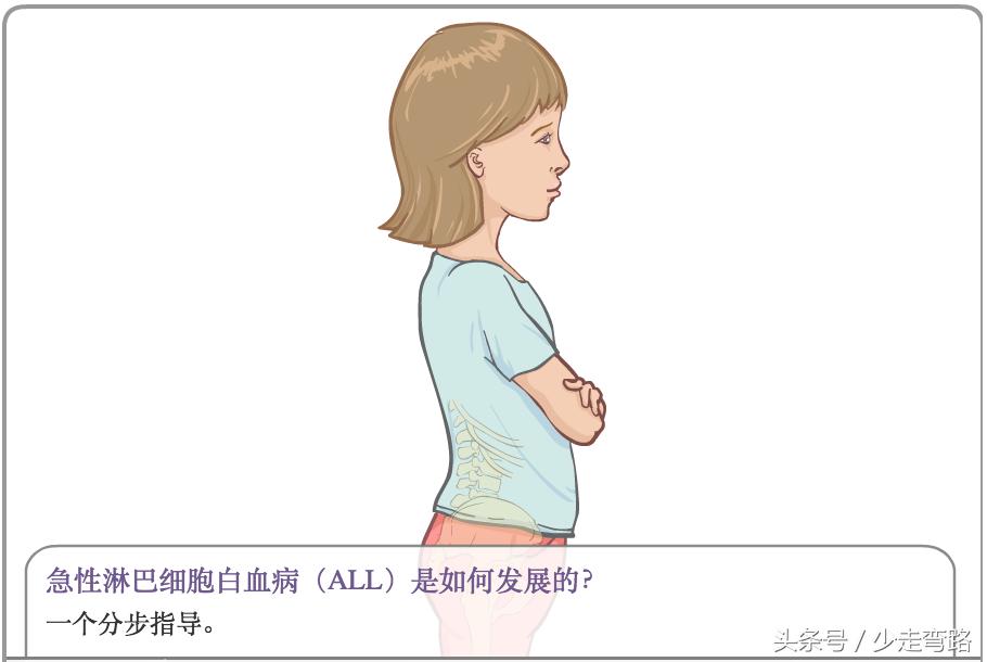 急性淋巴细胞白血病定义,小儿急性淋巴细胞性白血病